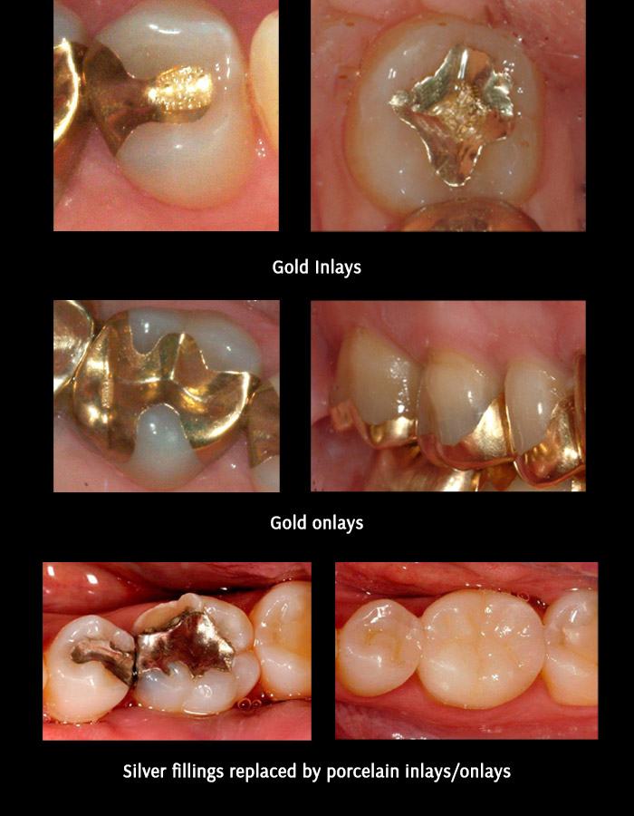 Dental Inlays And Onlays Napier Preserve Your Natural Teeth
